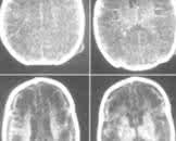 精制猴枣散 祖传秘方：新生儿颅内出血三剂根治精制猴枣散