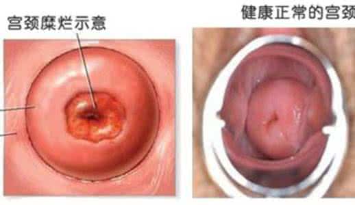 白带增多是怎么回事 私处白带增多是怎么回事