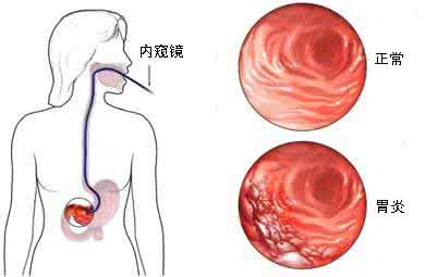 浅表性胃炎如何根治 胃炎