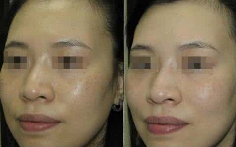 激光去斑疼吗 激光去斑疼吗 激光祛斑痛吗