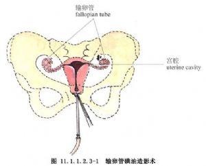 子宫输卵管造影怎么做 子宫输卵管造影 输卵管造影怎么做