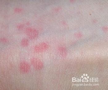 治疗湿疹小妙招 治疗湿疹小妙招 湿疹外用小妙招
