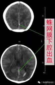 新生儿缺氧缺血性脑病 新生儿缺氧缺血性脑病 新生儿脑缺氧怎么改善?