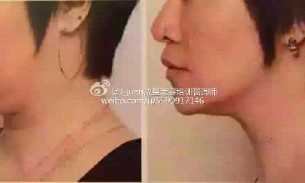 打溶脂针后还能抽脂吗 打溶脂针用回抽吗?