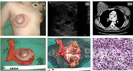 乳腺肿瘤如何治疗 乳腺肿瘤 如何治疗乳腺肿瘤