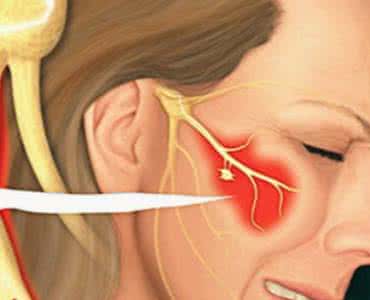 三叉神经疼怎么缓解 三叉神经疼 如何自我缓解三叉神经疼