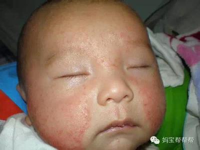 湿疹性皮炎多久能治愈 宝宝皮炎湿疹怎么治愈？