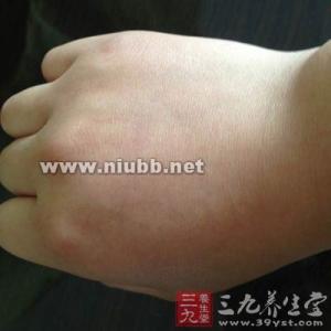 脂肪瘤最新治疗方法 脂肪瘤是什么 告诉你脂肪瘤的正确治疗