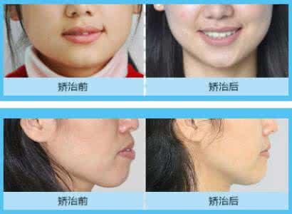 牙齿矫正移动速度 牙齿矫正移动速度 牙齿矫正为何不能一味地只求速度