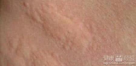 寒冷性荨麻疹症状 寒冷性荨麻疹症状 寒性荨麻疹的症状