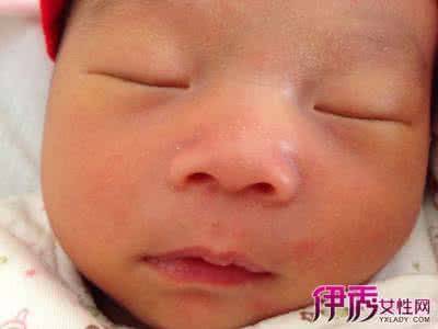 脸上小红点如何消退 脸上小红点如何消退 激光祛痘后脸上红红的，多久才可以消退呢？