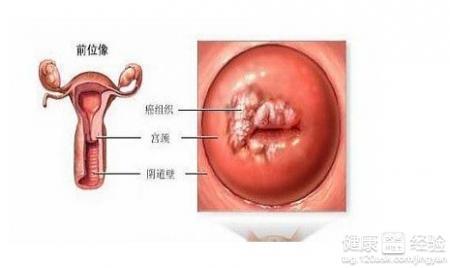 私处起小水泡 ​外阴部长水泡怎么回事