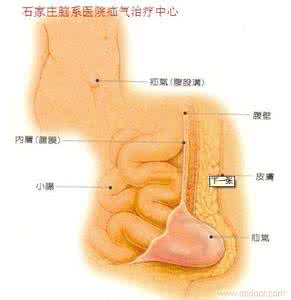 疝气的病因及治疗 孩子疝气怎么办 疝气的病因分析和有效治疗
