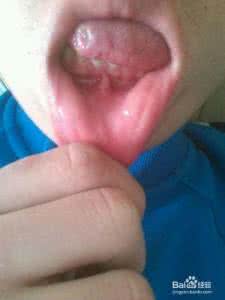 孕妇舌头溃疡怎么办 孕妇舌头溃疡怎么办 孕妇舌头溃疡的注意事项