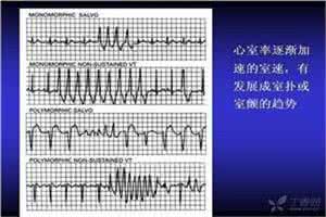 室颤的急救措施 室颤的急救措施 室颤如何急救措施