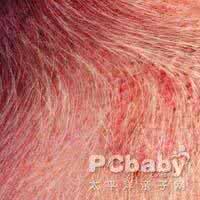 皮肤红斑 皮肤红斑4方