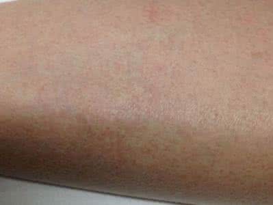 头孢过敏红疹几天能消 头孢过敏红疹几天能消 用头孢后起红疹怎么办?