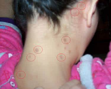 脖子长痘痘用什么药膏 脖子长痘痘是什么原因？