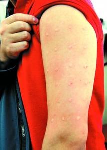 女性对避孕套过敏症状 女性精液过敏症状图片解析