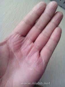 手指脱皮缺维生素 手指脱皮是缺什么维生素 5种原因可致手指脱皮