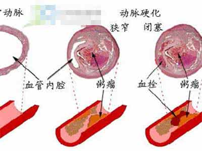 血管硬化的治疗方法 预防血管硬化 什么方法可以预防血管硬化