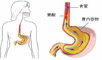 胃食管反流的症状 识破胃食管反流的伪装