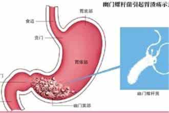幽门螺旋菌感染症状 幽门螺杆菌抗体 它有哪些症状表现