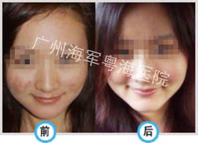 青春期痤疮如何治疗 青春期痤疮怎么治疗 有什么好方法
