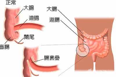 肠套叠的三大典型症状 肠套叠的症状 肠套叠的治疗和预防