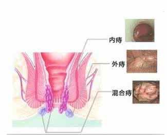 痔疮为什么会复发 痔疮老是复发 为什么老发痔疮？