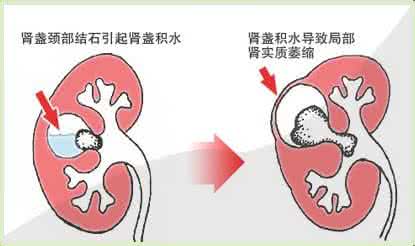 肾结石症状有哪些危害 肾结石有什么症状 什么是肾结石的症状危害