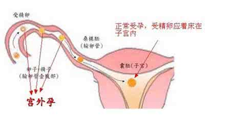 宫外孕和异位妊娠 宫外孕常识:异位妊娠