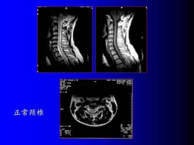 脊柱外科常见疾病ppt 脊柱常见疾病的MRI诊断