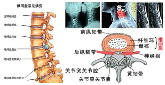 治疗颈椎病的偏方 中医治颈椎病