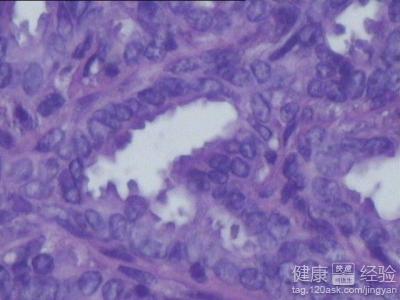 尖锐湿疣 外阴尖锐湿疣