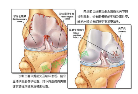 骨性关节炎的病因 中医对骨性关节炎病因病机的认识