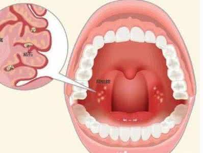 扁桃体结石口臭怎么办 小心口臭 可能是扁桃体结石