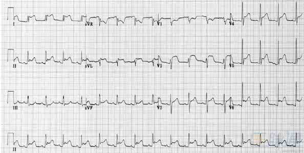 心电图诊断 心电图诊断要点