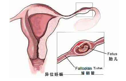 上环后会宫外孕吗 上环后会宫外孕吗 