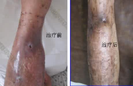 骨髓炎的治疗方法 什么是骨髓炎 它的治疗方法都有哪些