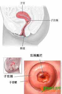 子宫颈炎治疗方法 子宫颈炎的治疗方法