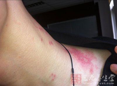 静脉曲张吃什么食物好 疾病预防 静脉曲张症状 对静脉曲张有益处的食物