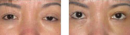 上睑松弛整形术 上睑松弛整形术 面部拉皮需要多少钱