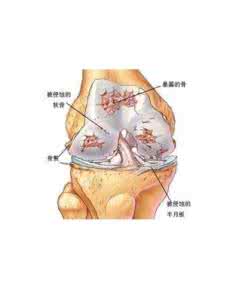 治疗内风湿性关节炎 治疗内风湿性关节炎 内风湿性关节炎诊断治疗