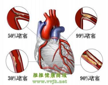 下肢动脉硬化和冠心病 预防动脉硬化 远离冠心病