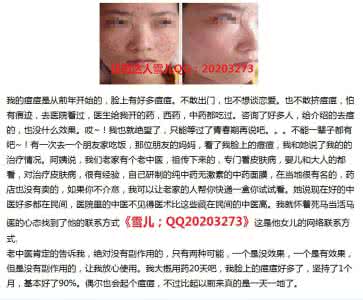 男生祛痘方法 青春期男生祛痘方法有哪些