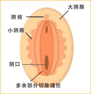 小阴唇肥大手术多少钱 小阴唇肥大手术多少钱 什么情况需要做阴唇肥大手术