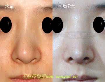 鼻头缩小手术方法 鼻头改小手术 大鼻头改小的手术方法是什么