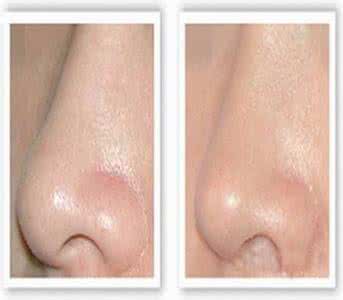 黑头导出液有用吗 黑头导出液 黑头导出液有用吗