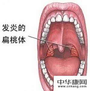 风寒感冒扁桃体发炎 风寒感冒扁桃体发炎 风寒感冒喉咙会发炎吗？